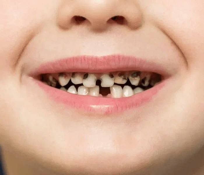 علاج أسنان أطفال • مجاني • كلية طب الأسنان