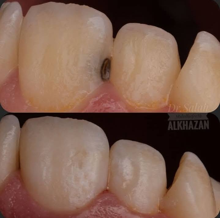 السلام عليكم العلاج مجاني للي عنده هيج حالة 
للتواصل واتساب ***********
او التواصل خاص 
العلاج تحت اشراف اطباء متخصصين 
العنوان:جامعة اشور شارع مطار المثنى

نص مكتوب في الصور:
- براء خالد غيلان طبيبة أسنان حشوات تجميلية قلع أسنان تنظيف أسنان وإزالة تكلسات تعويض أسنان مفقودة العلاج مجاني تحت إشراف مختصين *********** b0ara جامعة اشور شارع مطار المثنى
- تنظيف الاسنان وازالة التكلسات
- قلع جذور متبقية
- حشوات تجميلية للاسنان المكسورة
- Dr. Salah
- Abdullahteeth
- ALKHAZAN