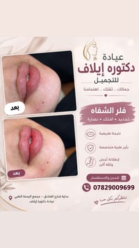 فلر الشفاه • د. إيلاف • شارع الفنادق