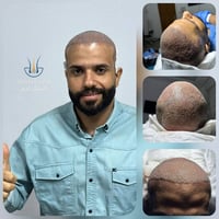 زراعة شعر • كثافة عالية • بدون ألم