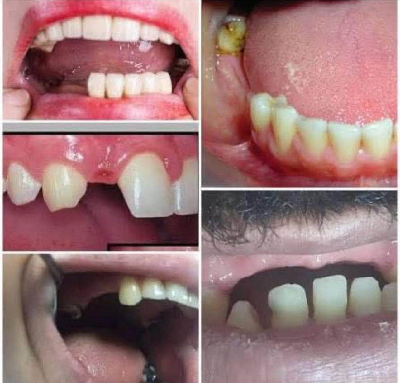 � خدمات علاجية مجانية للفم والأسنان 🦷
تعلن كلية طب الأسنان / جامعة بابل عن توفر خدمات علاجية مجانية بالكامل للفم والأسنان، تُقدَّم تحت إشراف أطباء مختصين.

📞 للحجز والاستفسار: ***********

🔹 الخدمات المتوفرة:

1️⃣ تنظيف الأسنان
2️⃣ أطقم الأسنان الجزئية المتحركة
3️⃣ الحشوات التجميلية   
4️⃣ قلع الأسنان التالفة والجذور المتبقية

📸 نماذج من الحالات والخدمات موضحة في الصور المرفقة.

📍 الموقع:
عيادات كلية طب الأسنان / جامعة بابل
حي الجامعة – الإسكان، مقابل الكراج الموحد

✨ الخدمات مجانية بالكامل وتُجرى تحت إشراف أطباء مختصين

نص مكتوب في الصور:
- عمل حشوات ضوئية تنظيف الأسنان و إزالة التكلسات و التصبغات قلع الأسنان التالفة والجذور المتبقية تعويض الأسنان المفقودة بطقم جزئي متحرك
- THE SIX CLASSES CLASS I Pits and fissures of molars, premolars, and lingual pits of anterior teeth. CLASS II Proximal surfaces of posterior teeth. CLASS III Proximal surfaces of anterior teeth without involving the incisal edge. CLASS IV Proximal surfaces of anterior teeth involving the incisal edge. CLASS V Cervical third of the facial or lingual surfaces of any tooth. CLASS VI OR Incisal edges of anterior teeth and cusp tips of posterior teeth.