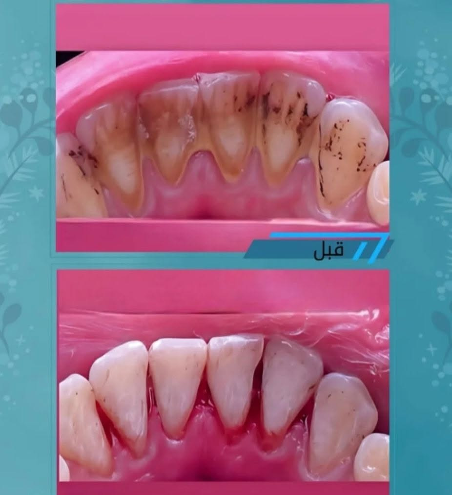 ✌🏻مميزون 😇💪🏻

 ✨ تنضيف الاسنان من جميع   التكلسات بجلسه واحده فقط 
           😇💪

من مركز 👈🏻 اليمامه التخصصي لطب الأسنان 💐

        بأيادي امهر الأطباء  
       👨🏼‍⚕️ 👨🏻‍⚕️👨‍⚕️👨🏽‍⚕️👨🏻‍⚕️

🦋 متواجدين وياكم طيله أيام الاسبوع من الساعه 4
 الئ ساعه 8  مۡسَـ(🍀)ـاء 

🌸 مجمع اليمامه الطبي التخصصي شارع ل 4000 الرئيسي

للأستفسار مراسله الصفحه 
او الاتصال على الرقم 
🌷 *********** 🌷
