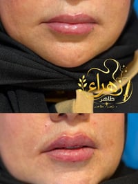 خصومات • فلر • ابر النضارة