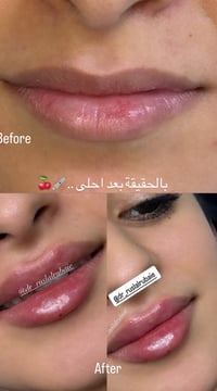 حقن تجميلي • ٣ مراحل • المسيب