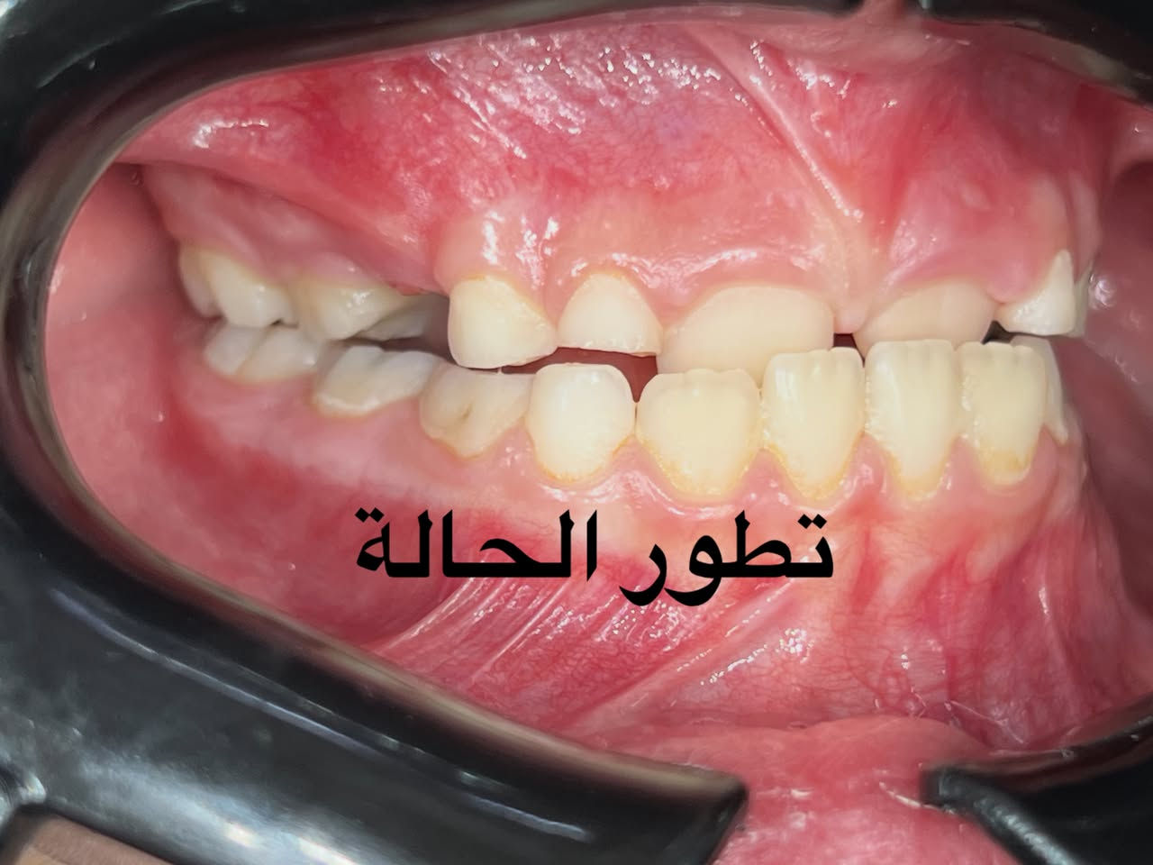 تقويم الأسنان • تقدم الفك السفلي • نفق الشرطة