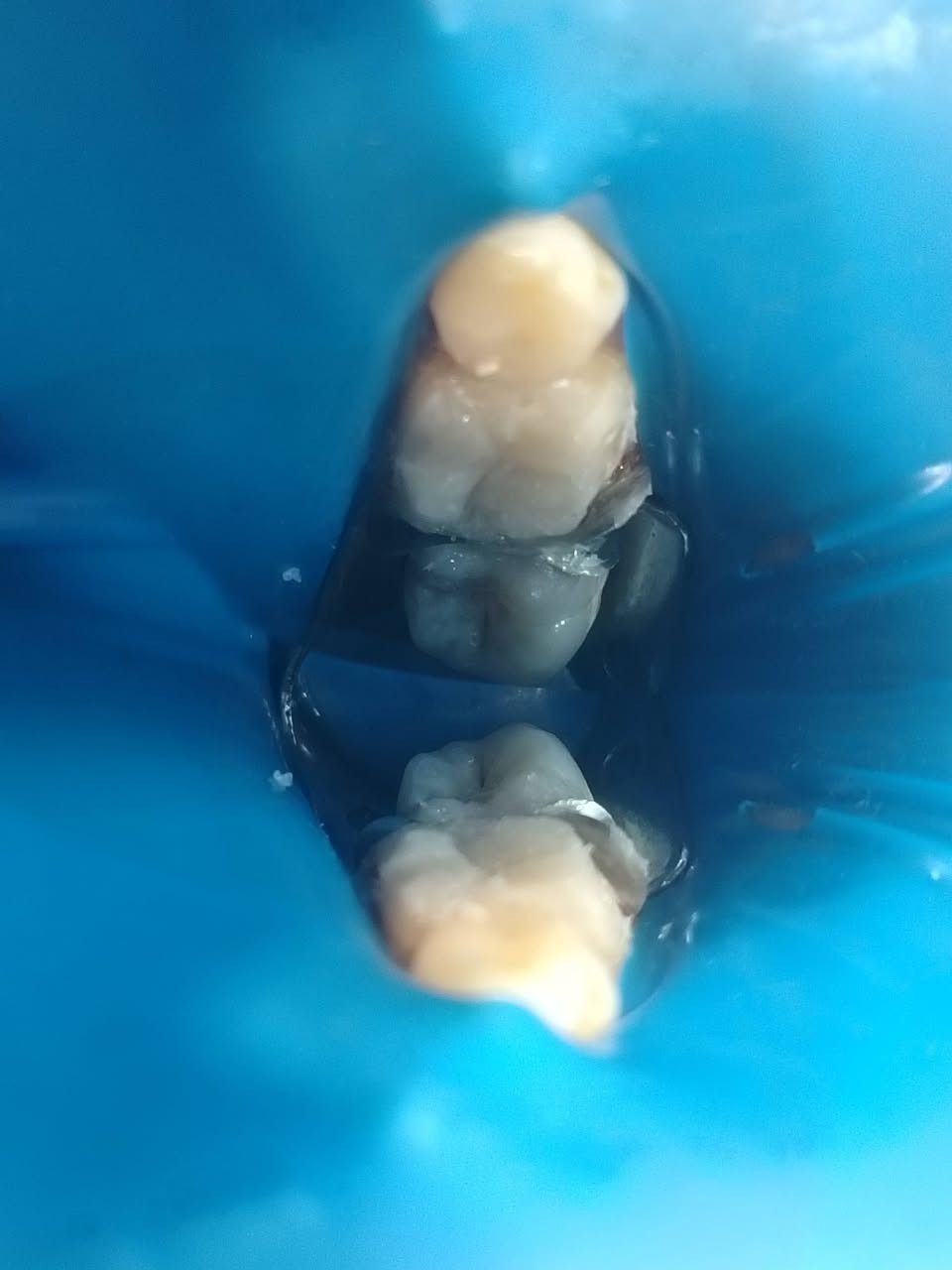 سلام عليكم ورحمة الله وبركاته
✨ فرصة مميزة لعلاج أسنانك بأسعار رمزية 🦷
طبيبة أسنان حاصلة على عدة شهادات ودورات تدريبية في مجال طب الأسنان، تقدم خدمات علاجية لمختلف الحالات بأسعار رمزية تصل إلى نصف السعر.
🔹 يشمل استقبال مختلف الحالات السنية
🔹 أسعار مناسبة ومخفضة
🔹 يتم توثيق ودراسة كل حالة ضمن بحث علمي بهدف تطوير الخبرة والجانب العلمي والسريري.
🔷 بيئه آمنه ومعقمه لكل مراجع ادوات خاصه به يتم التخلص منها بعد انتهاء الجلسه. 
📍 للحجز والاستفسار:
📱 واتساب: ***********

العلاج بامانه تامه ويوجد كارت ضمان مع تقرير كامل لحالة كل مريض وتتوفر صور لحالات علاجية من شغلنا على صفحتي الخاصه 📸
