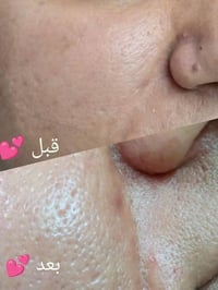 تقشير طبي • خاص بنات • ٣ جلسات