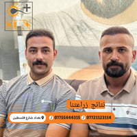 زراعة شعر بعدد مفتوح من البصيلات دون تشوه المنطقة المانحة  ب 650 الف ب...