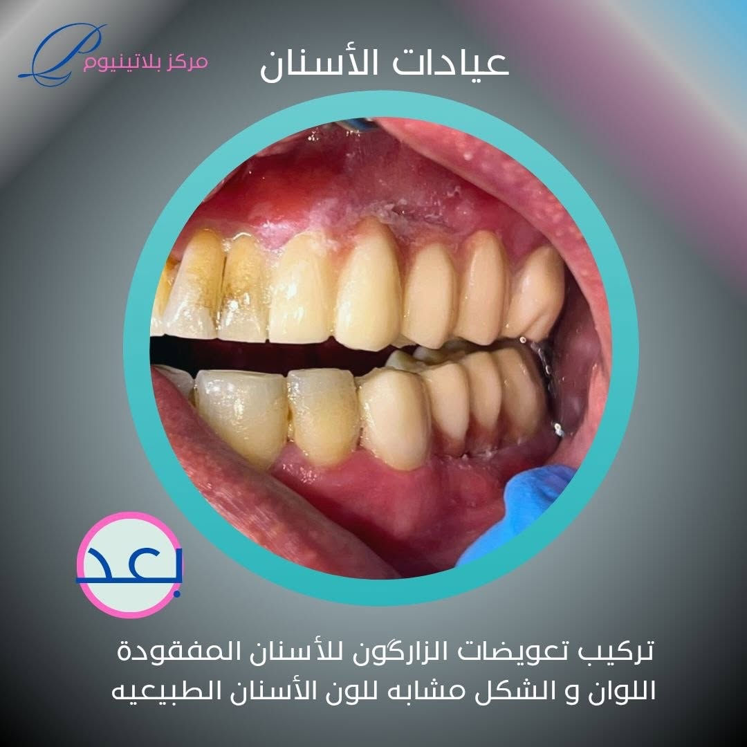 ⁨ مركز بلاتينيوك كلينك الطبي 
عيادات الأسنان #
⁨ 📌 موقعنا: بغداد – المحمودية – حي 17 – مجاور منفذ كرار الطائي_باتجاه معهد اوراس 
📞 للحجز:
***********

#بغداد #بلاتينيوم_كلينك #المحموديه #المحمودية⁩
