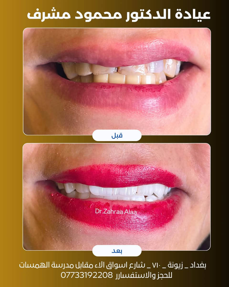 ✨ ابتسامة تخطف العين… وتبقى بالبال 😍🦷

مو بس جمال أسنان، هي تناسق، نعومة، وثقة بكل ضحكة 🤍
خلّي ابتسامتك تكون أجمل تفصيل بوجهك.

📍 زيونة – شارع أسواق الاء، مقابل مدرسة الهمسات
📞 ***********

#جمال_الابتسامة #ابتسامة_هوليوود #تجميل_الأسنان #عيادة_الدكتور_محمود_مشرف #بغداد
