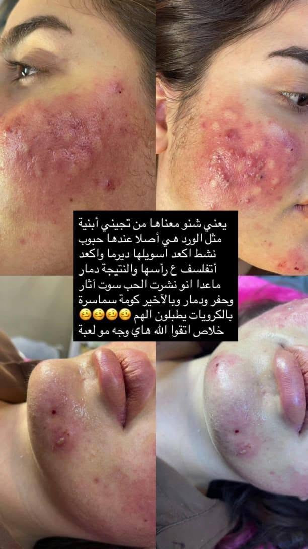 خانقين • فلر الشفايف • بوتوكس