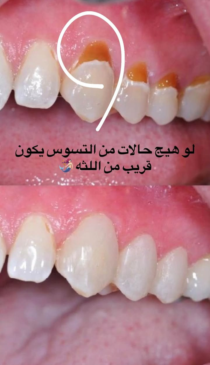 � رجعت العيادات، وراح أرجع أستلم حجوزات!
إذا عندك/ج سن مأجل علاجه من زمان.. يمكن هسه وقته! 🦷🤍

🚨 جبتلكم خبر حلو هم!
صرت أستلم أطفال وأعتني بأسنانهم 👧🏻🧒🏻🦷
إذا يحتاجون علاج للتسوس، ونقدر نسويلهم تطبيق فلورايد لحماية أسنانهم ✨

وكذلك أستلم حشوات جذور للأسنان الأمامية 🦷

📍 العنوان: جامعة التراث – المنصور
☎️:***********
Inst:dr__.manar

الحالات تشمل:
🦷 الحشوات
🦷 حشوات الجذور
🦷 القلع
🦷 تنظيف الأسنان
🦷 تركيب طقم كامل للأسنان المفقودة

🤍 علماً أن العلاج مجاناً وتحت إشراف الأطباء الاختصاص.

وسيتم تنزيل الحالات المطلوبة، فإذا حابين تكون حالتكم من ضمن الحالات، راسلوني حتى يتم تثبيت الموعد 🌷

وأتشرف جداً أكون أنا اللي أتابع حالاتكم 🤍🫶�

نص مكتوب في الصور:
- الي عدهم هيج جذور متبقية راسلوني
- الي عدهم هيج حالات يحتاجون تنظيف
- و الي هيج شمنتظرين ؟ تعالوا تنظيف مجاني FREE
- مثل هيج حالات من الاسنان الاماميه تكون مكسورة او متآكله همين نرجع الابتسامه الحلوه الكم
- لو هيج حالات من التسوس يكون قريب من اللثه