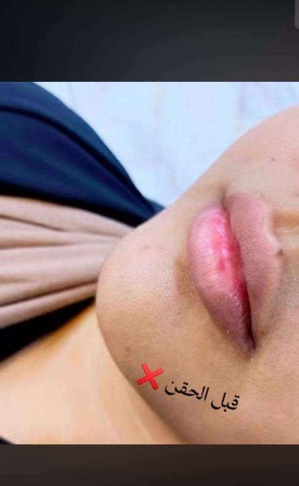 جمال الفلر بيد خبيرة التجميل عروضنا مستمرة مع احلى الرسمات الكرزية 🦋🦋

نص مكتوب في الصور:
- قبل الحقن