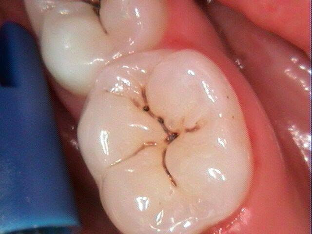 🦷✨ علاج أسنان مجاني وتحت إشراف أطباء اختصاص ✨🦷

إذا عندك مشكلة بأسنانك ومأجل علاجها، هاي فرصتك 🤍

أوفر لكم علاج وفحوصات أسنان مجاناً ضمن العيادات التعليمية، وبإشراف مباشر من أطباء أسنان اختصاص 👨‍⚕️🦷

🔹 تنظيف الأسنان وإزالة التكلسات
🔹 الحشوات ومعالجة التسوس
🔹 قلع الأسنان عند الحاجة
🔹 صناعة وتركيبات الأسنان
🔹 فحص وتشخيص ومتابعة الحالة
اذا عندك حالة كهذه راح نعالجها بل جامعة و تحت إشراف أطباء اختصاص 

📍 عيادات طب الأسنان – جامعة المستقبل
📍 سريع – حلة – نجف

💯 العلاج مجاني
👨‍⚕️ تحت إشراف أطباء اختصاص
🦷 الاهتمام بالحالة خطوة بخطوة

📩 إذا مهتم أو تعرف شخص يحتاج علاج، راسلني خاص او على الرقم واتساب *********** حتى ننسق الموعد.
