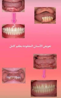 عيادات جامعة الكوفة • علاج مجاني • طقم أسنان