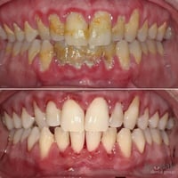تنظيف أسنان • عرض الجمعة • سبوداك