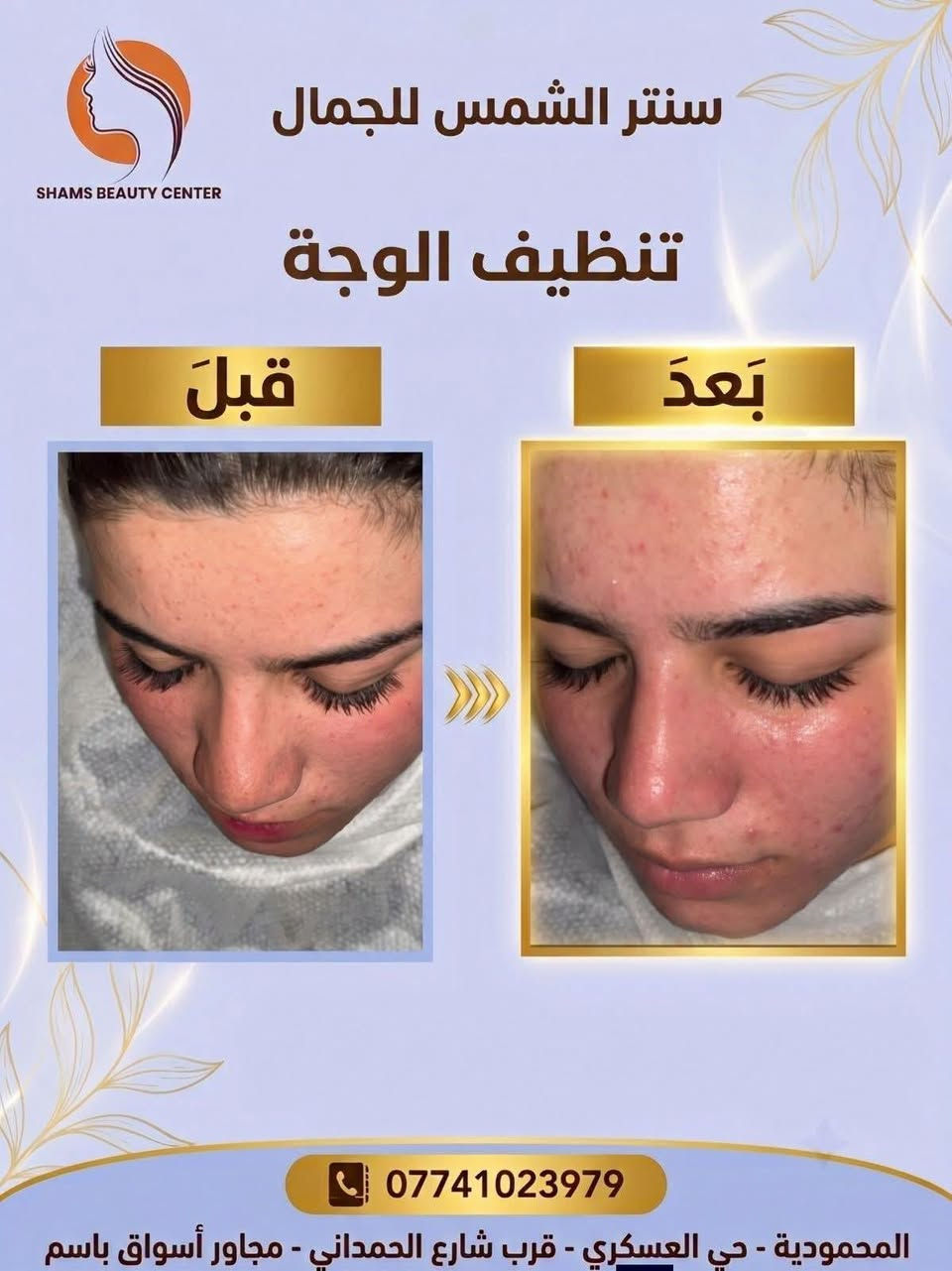 سنتر الشمس للعناية بالشعر والبشرة

نص مكتوب في الصور:
- SHAMS BEAUTY CENTER العناية بالأقدام - تنظيف ملكي ودلال خدمة تنظيف القدم الملكي قَبْلَ بَعْدَ وداعاً للخشونة، أهلاً بالنعومة والجمال! *********** المحمودية - حي العسكري - قرب شارع الحمداني - مجاور أسواق باسم
- SHAMS BEAUTY CENTER عروض الأظافر : إزالة أظافر - 5 آلاف تنظيف يد - 5 آلاف تنظيف قدم - 10 آلاف جلش - 15 ألف أكريليك + ديزاين - 20 ألف أكريليك أظافر - 25 ألف تنظيف اليد بالشمع - 10 ألف ***********
- SHAMS BEAUTY CENTER عروض الرموش : - إزالة رموش - 5 آلاف - رموش أسبوعية - 10 آلاف - رموش تكنيك روسي - 15 ألف - رموش كوري - 15 ألف - رموش لفتنك - 20 ألف ***********
- سنتر الشمس للجمال SHAMS BEAUTY CENTER تنظيف الوجة قَبْلَ بَعْدَ *********** المحمودية - حي العسكري - قرب شارع الحمداني - مجاور أسواق باسم
- SHAMS BEAUTY CENTER رسم وتجميل الحواجب الدائم خدمة التاتو للحواجب قَبْلَ بَعْدَ *********** المحمودية - حي العسكري - قرب شارع الحمداني - مجاور أسواق باسم