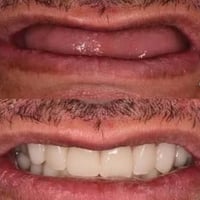 طقم كامل متحرك • مجاناً • فاقد الأسنان