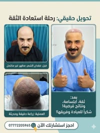 زراعة شعر • استعادة الثقة • اليرموك