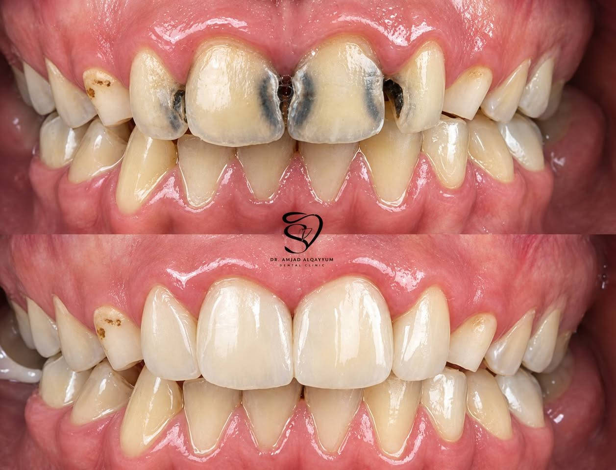 🦷 العلاج مجاني للحالات
بإشراف نخبة من الأطباء المختصين وذوي الخبرة والكفاءة، لضمان تقديم رعاية وعلاج بمستوى مهني مميز. 🤍
📍 عيادات بيارق العميد – السعدية، خلف مول الحارث
📩 للتواصل: خاص أو واتساب
📱 ***********

نص مكتوب في الصور:
- الدكتوره زهراء كريم العلاج مجاني للحالات بإشراف نخبة من الأطباء المختصين وذوي الخبرة والكفاءة، لضمان تقديم رعاية وعلاج بمستوى مهني مميز. ابتسامتك .. تستحق الأفضل قلع الاسنان والجذور المتبقيه الحشوات الضوئيه التجميليه تنظيف الأسنان من التكلسا ت وتلميعها تعويض الأسنان المفقوده بالتراكيب السنيه المتحركه عيادات بيارق العميد السعدية - خلف مول الحارث *********** للتواصل: خاص أو واتساب
- DR. AMJAD ALQAYYUM DENTAL CLINIC