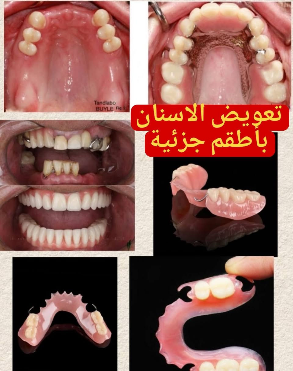 السلام عليكم ♥️♥️متوفر علاج مجاني بالكامل اللي عنده حشوة تنظيف وقلع تعويض اسنان وتحت أشراف مجموعة من الاستاذة النخبة الاختصاص في عيادات جامعة دجلة 
للتفاصيل اكثر واتساب +9647762435273

نص مكتوب في الصور:
- تنظيف وازالة التكلسات
- Class 1 حشوات تجميلية دائمة
- قلع الاسنان التالفة والمتحركة والجذور المتبقية
- تعويض الاسنان باطقم جزئية