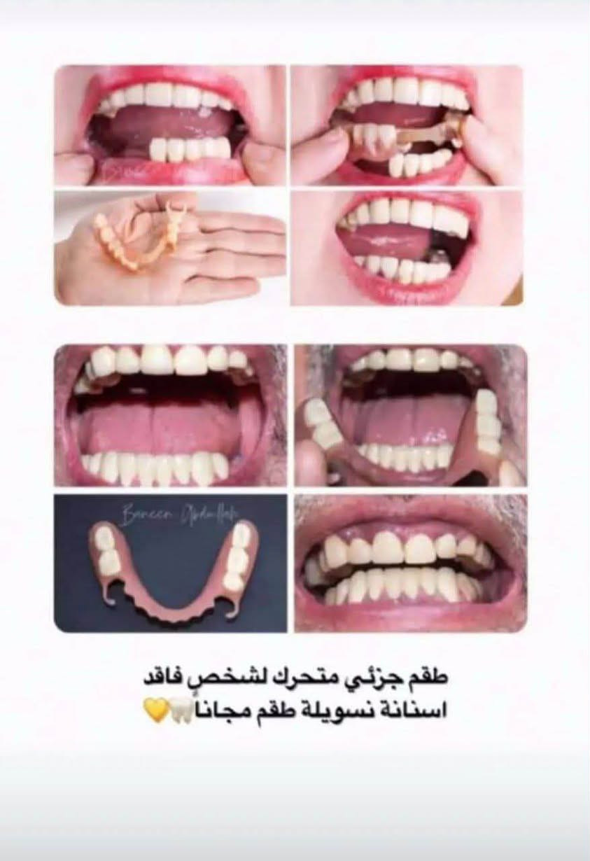 تعلن عيادات جامعة المنارة عن استقبال المرضى لإجراء العلاجات السنية مجانًا 🤍
• حشوات
• تنظيف وإزالة التكلسات
• قلع
• علاج جذور
• وغيرها من العلاجات حسب الحالة

📍 الموقع: عيادات جامعة المنارة – قرب مستشفى الصدر

📞 للاستفسار والحجز:
***********

نص مكتوب في الصور:
- اللي محتاج حشوات أمامية مثل هذه الصور يراسني العلاج مجاناً
- يل عده هيج حالات تستحق قلع من أسنان تالفه او لبنية أو بقايا جذور يتواصل ع الخاص حتى نثبتله حجز ✨ مجاناً
- طقم جزئي متحرك لشخص فاقد اسنانة نسويلة طقم مجانا 🤍🦷
- الحالات التي نستقبلها داخل العيادات علّما أن المعالجه مجانية حشوات معدنية و ضوئية قبل بعد قبل بعد قبل بعد قبل بعد
- الي عندة اسنان تالفة او جذور متبقية ويريد قلع يراسني ويكون مجاناً