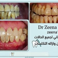 علاج مجاني • أسنان أطفال • يرموك كلية الحكمة