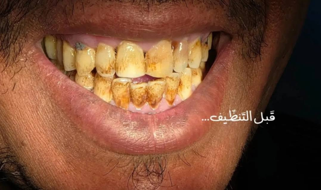 تنظيف أسنان • طالب طب اسنان • السيديه جامعة السلام