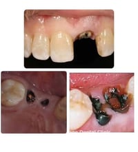 ​🦷 جميع الخدمات التالية مجانًا ✨ ✅ حشوات تجميلية ضوئية دائمة ​✅ تعويض ...