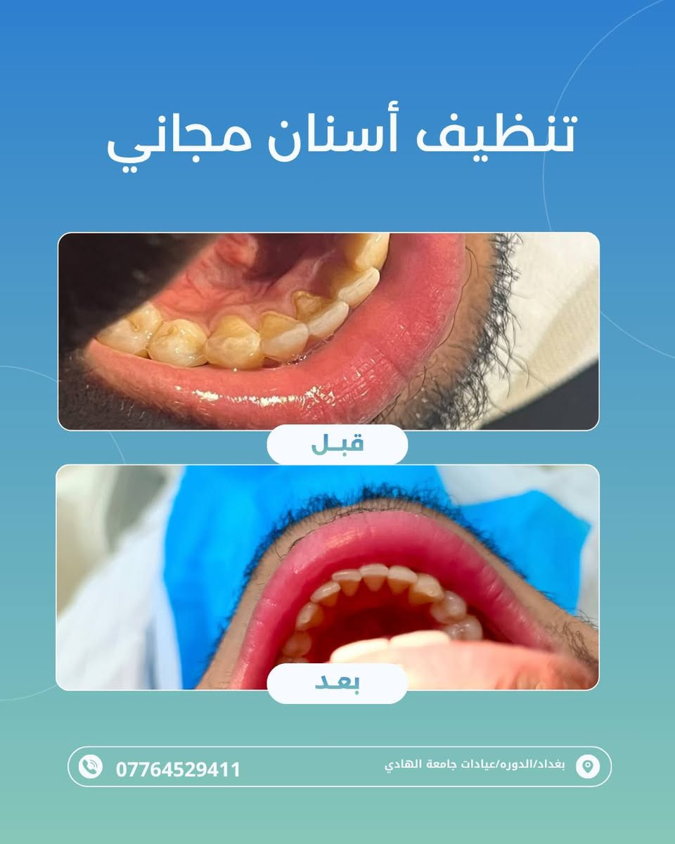 تنظيف أسنان • مجاني • جامعة الهادي