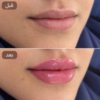 تجميل • شفايف • قبل وبعد