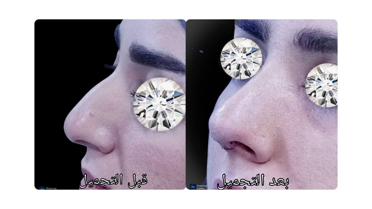 Natural Rhinoplasty
Alyasiery clinic for Rhinoplasty
***********

