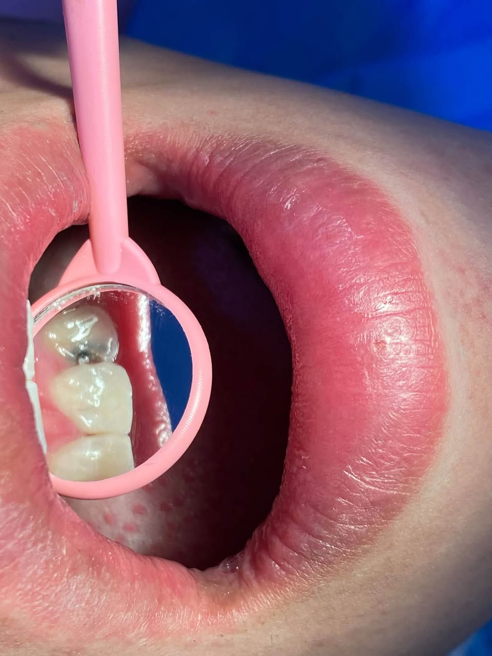 السلام عليكم 
 حشوات  تجميليه ، قلع جذور متبقيه وقلع جراحي 
تنظيف الأسنان من التكلسات والتصبغات 
كُل هذا تحت إشراف دكاتره مختصين 
علماً العلاج مجاني 🔥🔥 
العنوان : حي النقيب عيادات جامعه الصفوه 
للحجز ؏ هذا الرقم :***********
