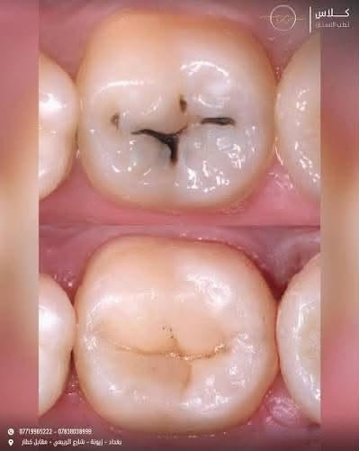 متوفر علاج مجاني💗!

تنظيف اسنان وإزالة التكلسات .
حشوات ضوئية تجميلية .
وقلع الاسنان والجذور المتبقية .
تعويض الاسنان المفقودة الخلفية بطقم .

الي يحتاج يعلق او يدخل خاص 
العنوان جامعة النور ، مقابل دجلة ستي

نص مكتوب في الصور:
- كلاس لطيب الأسنان *********** - *********** بغداد - زيونة - شارع الربيعي - مقابل قطار