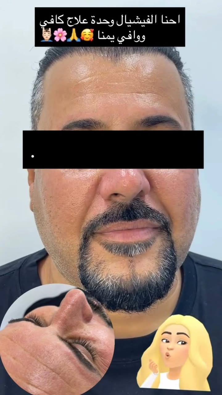خانقين • فلر الشفايف • بوتوكس