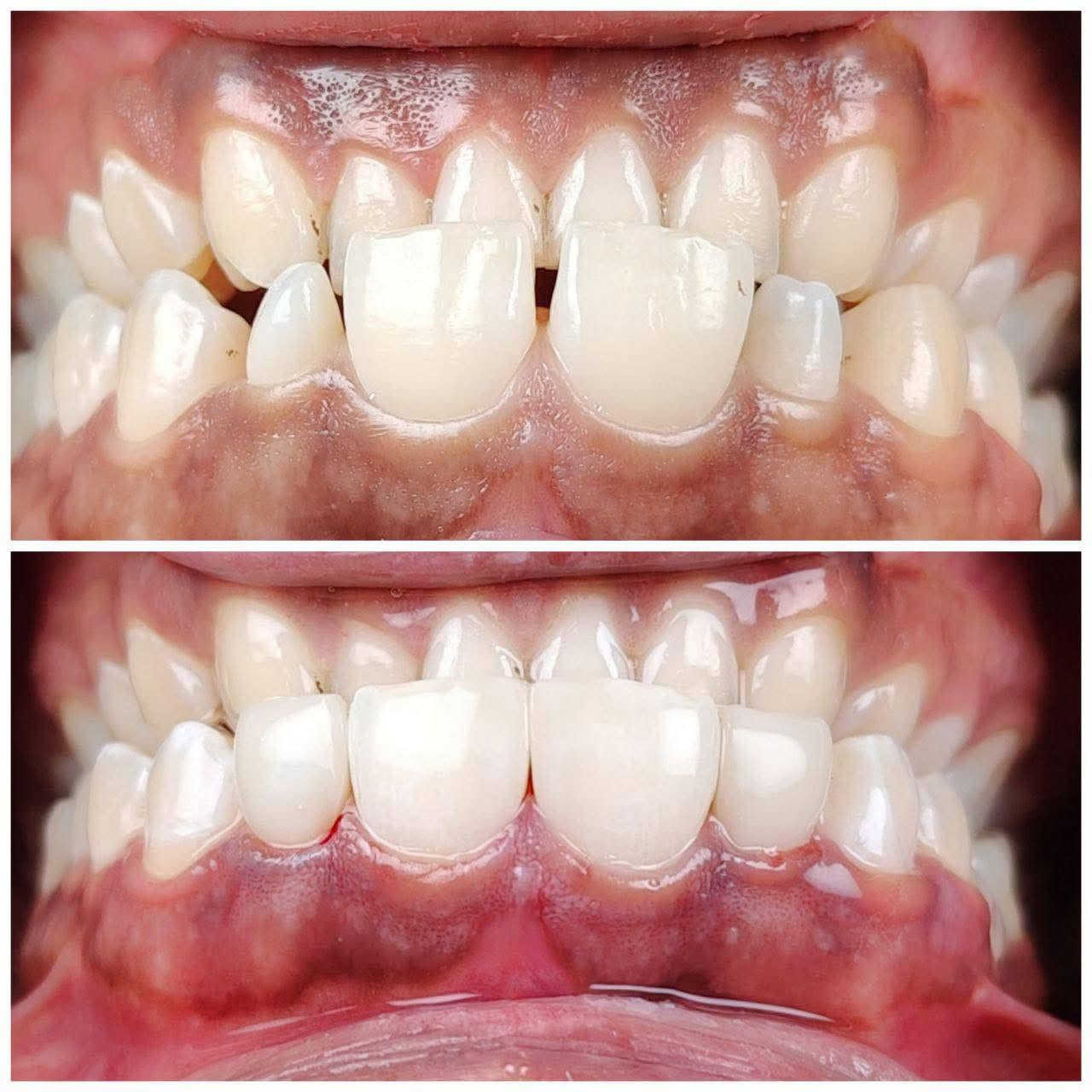 عروض الجمعه تنضيف أسنان ب20 فقط بدل 50 
الحجز على الرقم التالي ***********

نص مكتوب في الصور:
- Spudak dental group