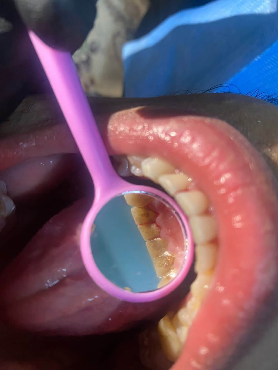 العلاج مجاناً • حشوات تجميلية • قلع جذور