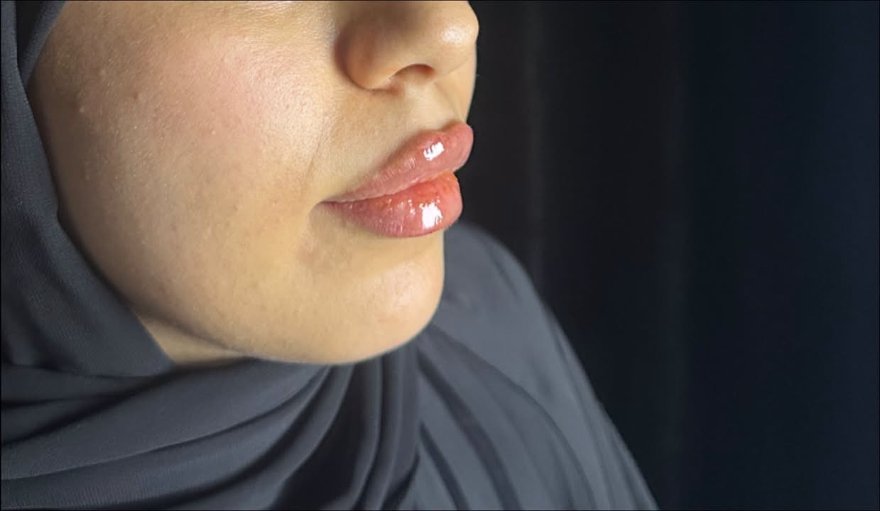 خلي ابتسامتج تحچي عنج… وشفايفج تكمل جمالج. 💋
* لأن الجمال الحقيقي هو التناسق، مو المبالغة
الدكتورة ساره عدنان
