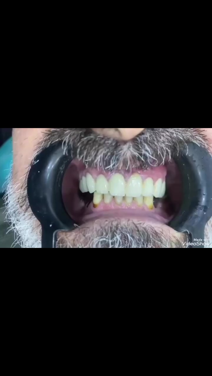 إعادة تأهيل أسنان • تجميل أسنان • مركز برو