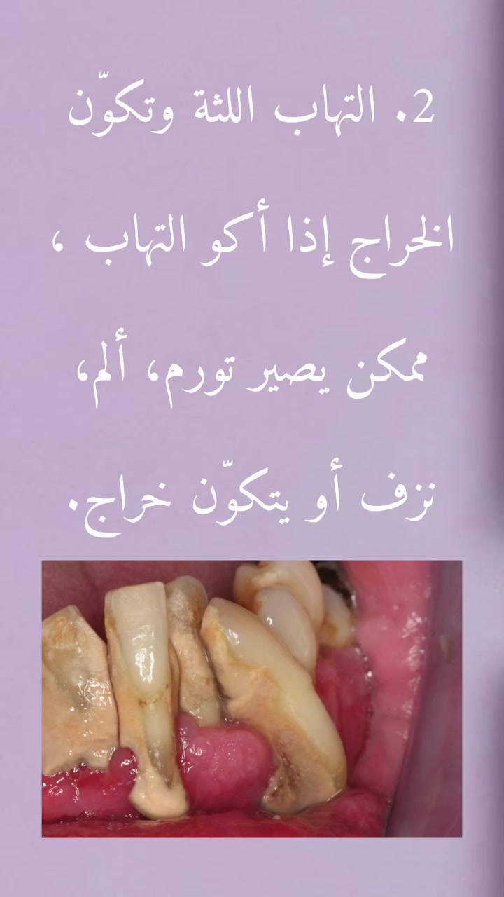 قلع مجاناً • تنظيف أسنان • جامعة كلكامش