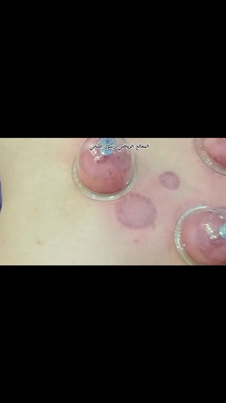 حجامة • مساج • رسول الكناني