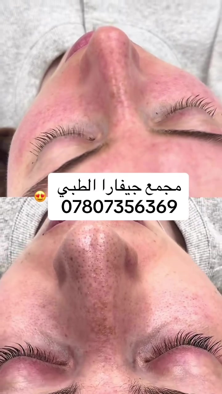 هايدرافيشل • تنظيف البشرة • جبلة
