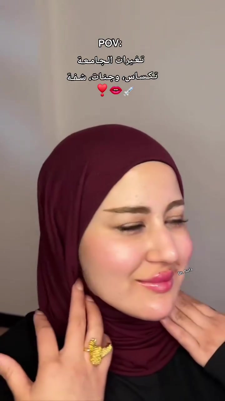فلر شفة • تجميل • د وليد الحمداني