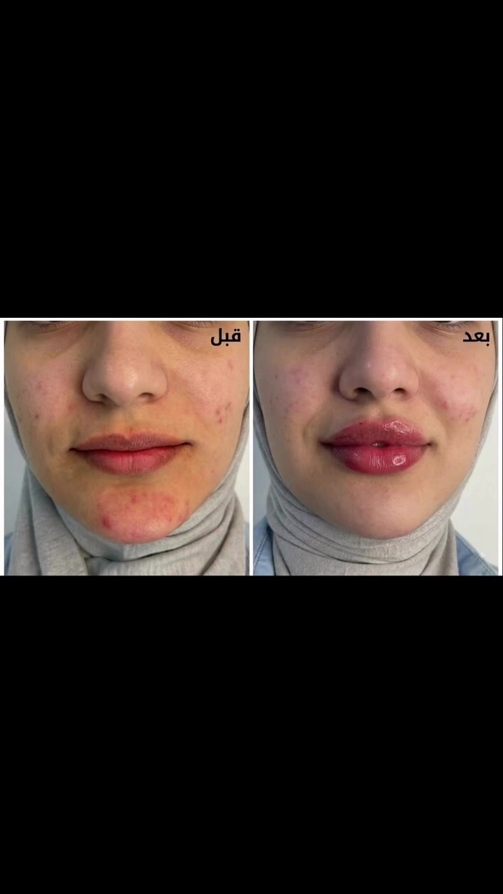 نتائج الجلسه الثانيه فقط من جلسات علاج حب الشباب+ فلر شفه 

المركز السوري الطبي 
😍😍😍 😍😍😍نستخدم افضل أنواع الفلر 💉🥼🩵 
كافة خدمات التجميل متوفرة بمركزنا ( للنساء والرجال )
وتحت أيادي أطباء اختصاص
متواجدين كل أيام الأسبوع 
المعاينة مجانا

الدكتورة اريج هائل الحيدري ❤️❤️
#فلر #مدينة_الصدر #المحمودية
#المركز_السوري_الطبي
العنوان المحمودية تقاطع العزاب(المجمع) قرب مقر الفوج الثاني سابقاََ
للحجز والاستفسار مراسلة الصفحة أو الاتصال على الأرقام التالية 📱*********** ***********
