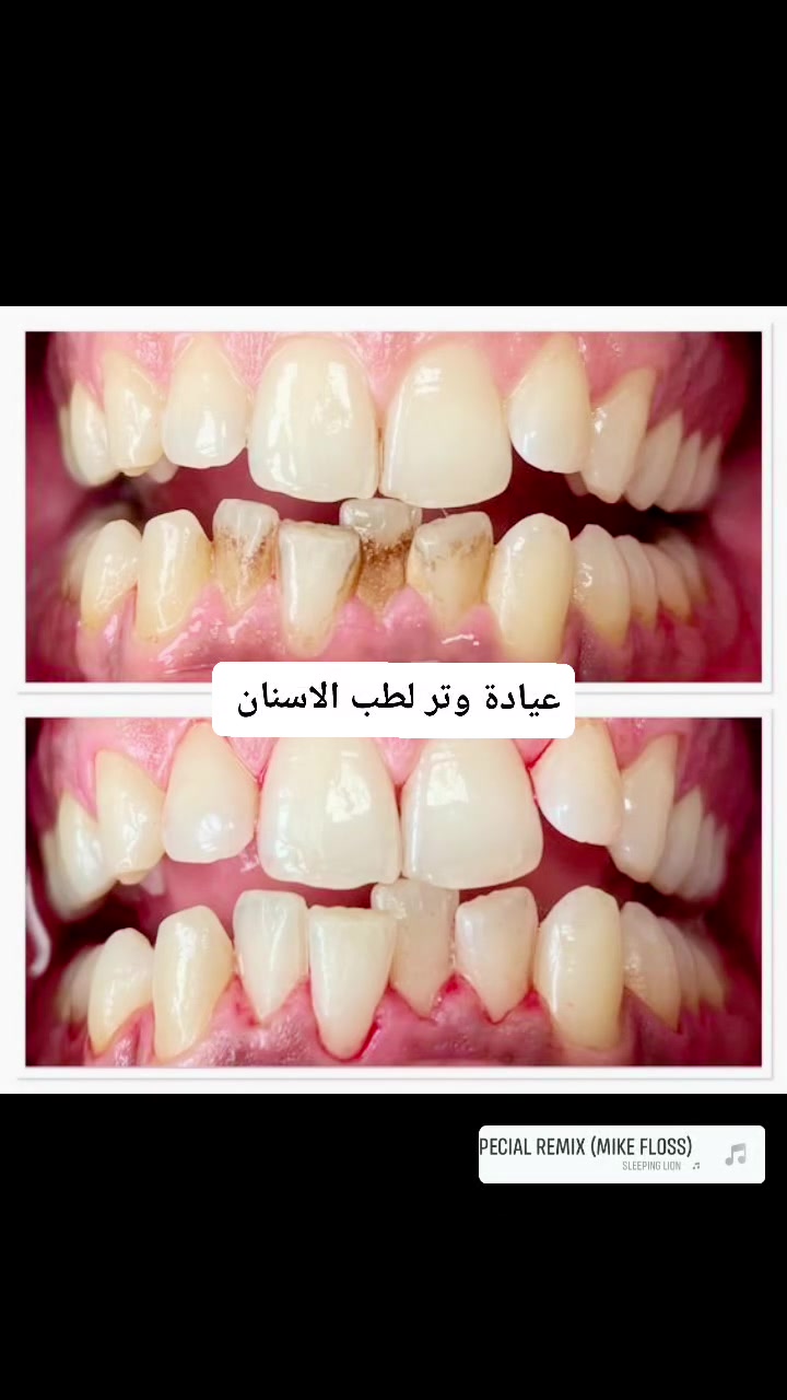جلسة تنظيف الاسنان لازالة التكلسات والتصبغات والحصول على لثة صحية وابتسامة جميلة 🦷✨ 
العنوان حي الجهاد الحمدانية قرب حسينية علي ولي الله شارع 15 
للاستفسار والتواصل على الخاص او رقم الهاتف *********** او *********** 

.
 #اسنان #تنظيف #حي_الجهاد
