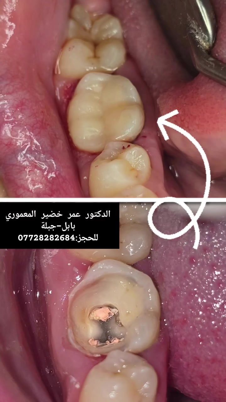 علاج تسوس • دكتور عمر المعموري • بابل-جبلة