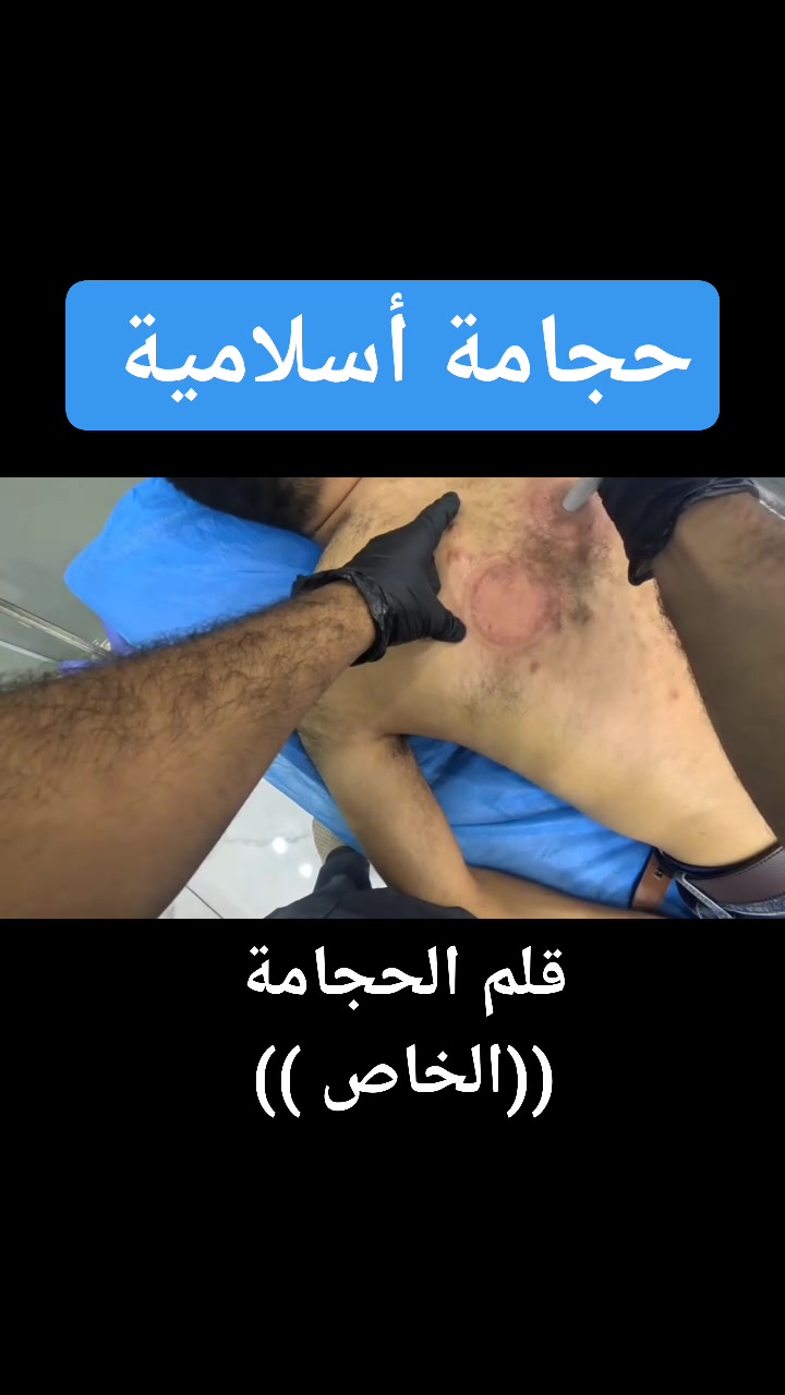 حجامة أسلامية بقلم الحجامة الخاص _ العنوان :كوفة_منطقة اليوحداري _ قرب محطة بركة الساقي _عمود52✨للتوصل والحجز :***********
