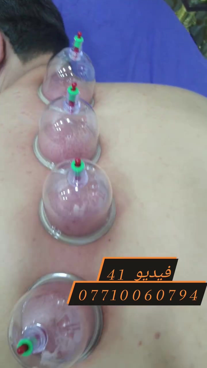 (فيديو جلسة حجامة) 41
العنوان بغداد_الكرخ الجعيفر_شارع الشيخ معروف قرب جامع رشيد دراغ
الحجز او الاستفسار ***********
 #طب_تكميلي #حجامة_رياضية #حجامةالطائي #مركزحجامةالكرخ
