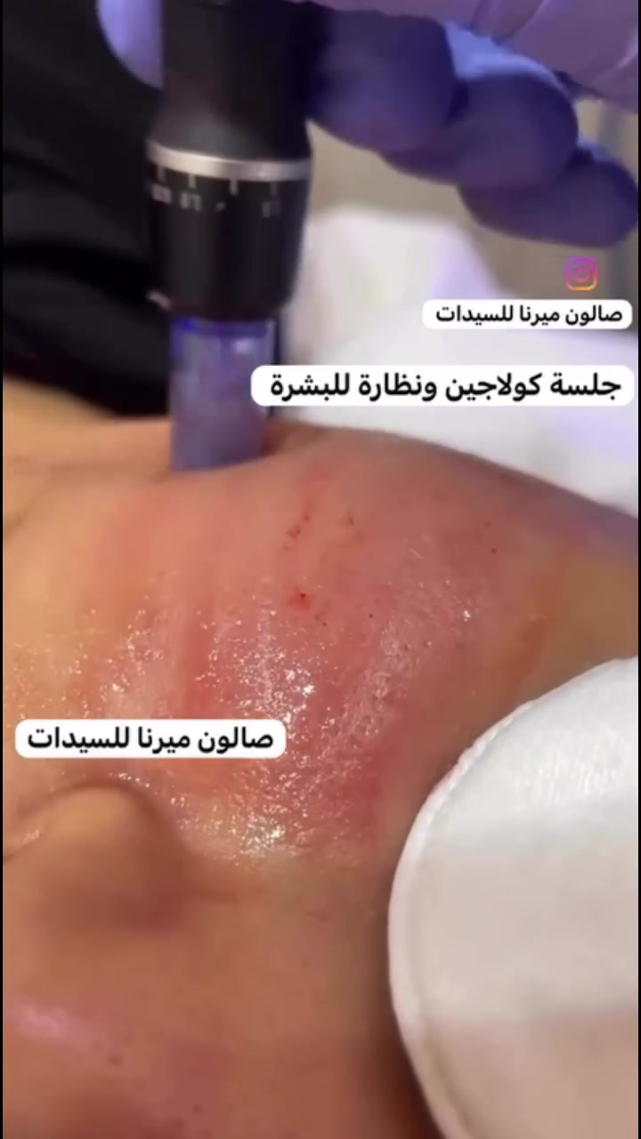 جلسة النظارة وتحفيز الكولاجين تساهد على سد المسامات الواسعة 
صالون ميرنا للسيدات 
بغداد حي البساتين مدخل جامع المرتضى***********
