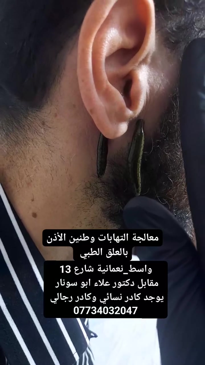 العلق الطبي • طنين الأذن • النعمانية